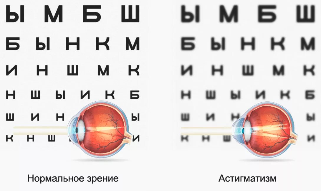 Зрение 4 25. Зрение минус 1. Максимальный минус зрения. Зрение -2.5. Зрение человека при минус 2.