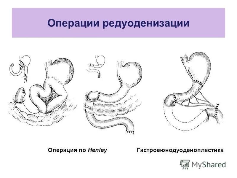 Операция синдром. Гастроеюнодуоденопластика по захарову-генлею. операция захарова генлея. операция захарова хенли. реконструктивная гастроеюнодуоденопластика.