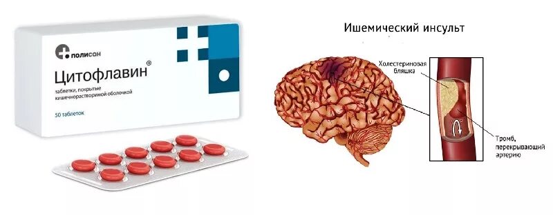 Лекарства для восстановления инсульта. Препараты после инсульта ишемического. Таблетки после инсульта Цитофлавин. Цитофлавин при ишемическом инсульте. Препараты для восстановления сосудов головного мозга после инсульта.