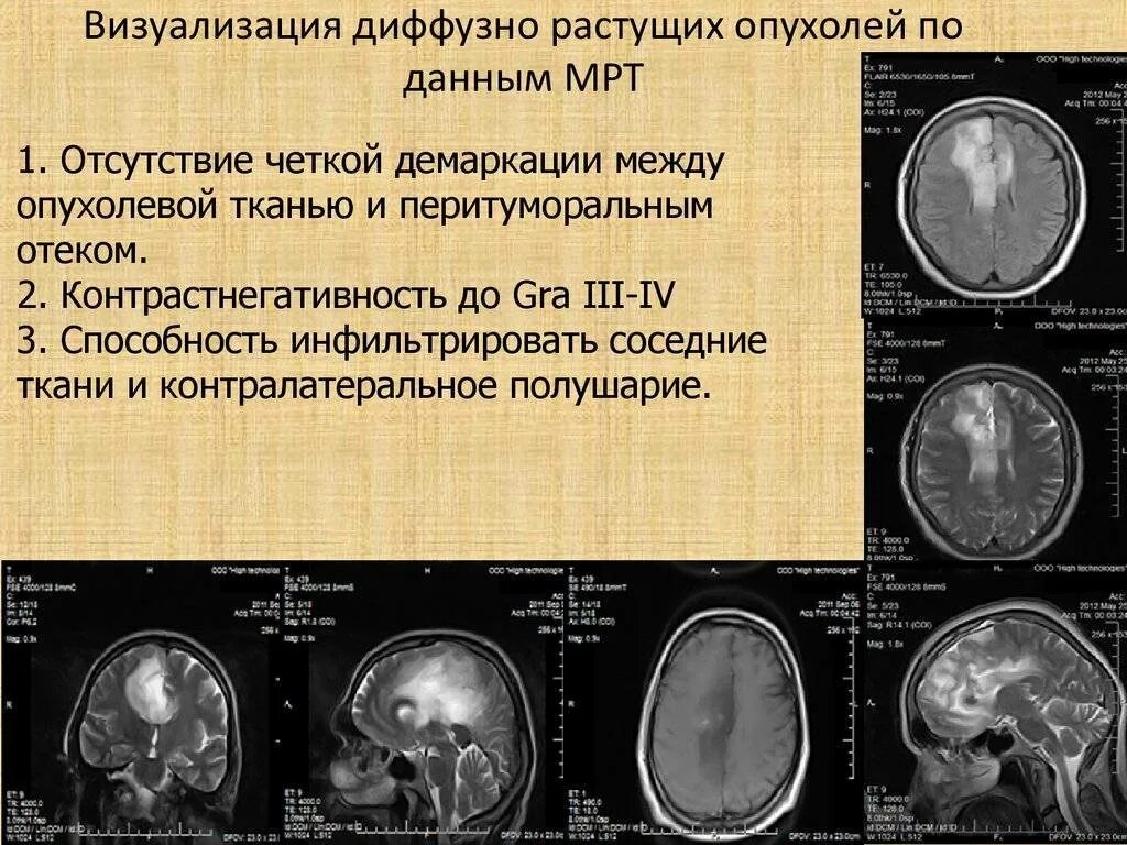 Как понять диффузно. Диффузного объемного образования головного мозга. диффузная опухоль головного мозга. диффузная опухоль головного мозга мрт.