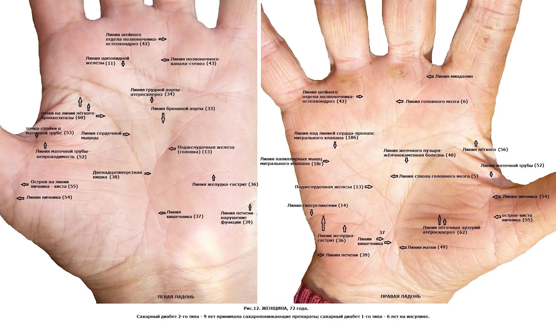 Определить заболевание по рукам. Линия печени на руке. Линия печени на ладони. Хиромантия линия печени.