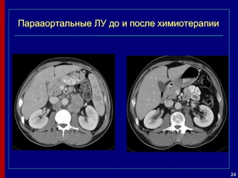 Кт после химиотерапии. Химиотерапия лимфомы. ВИЧ ассоциированные лимфомы. Лимфома после химиотерапии. Химиотерапия при лимфоме Ходжкина.