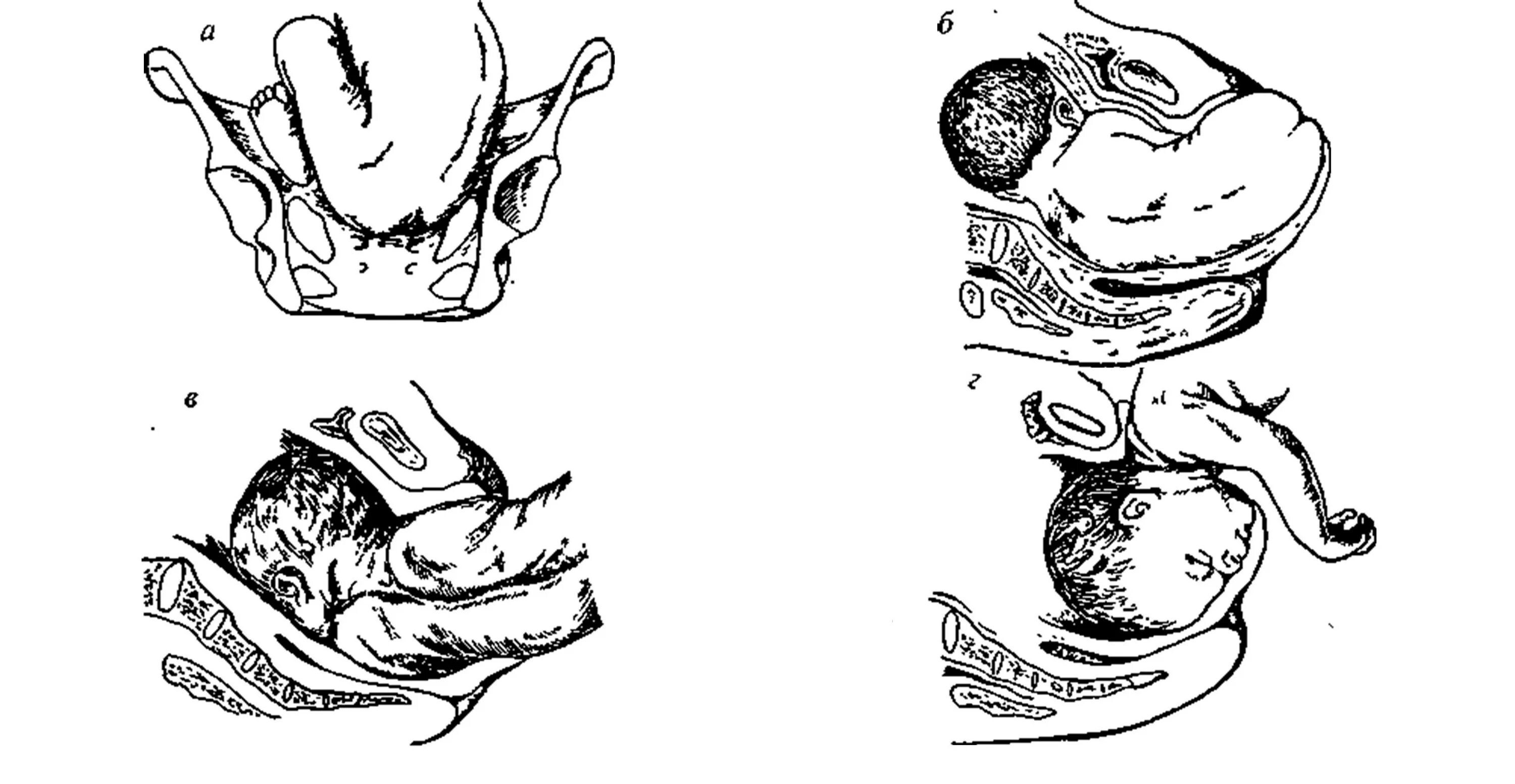 Механизм родов при тазовом предлежании плода. Биомеханизм родов при тазовом предлежании. Тазовое предлежание плода биомеханизм родов. Биомеханизм родов при тазовом предлежании плода. Роды по горизонтали
