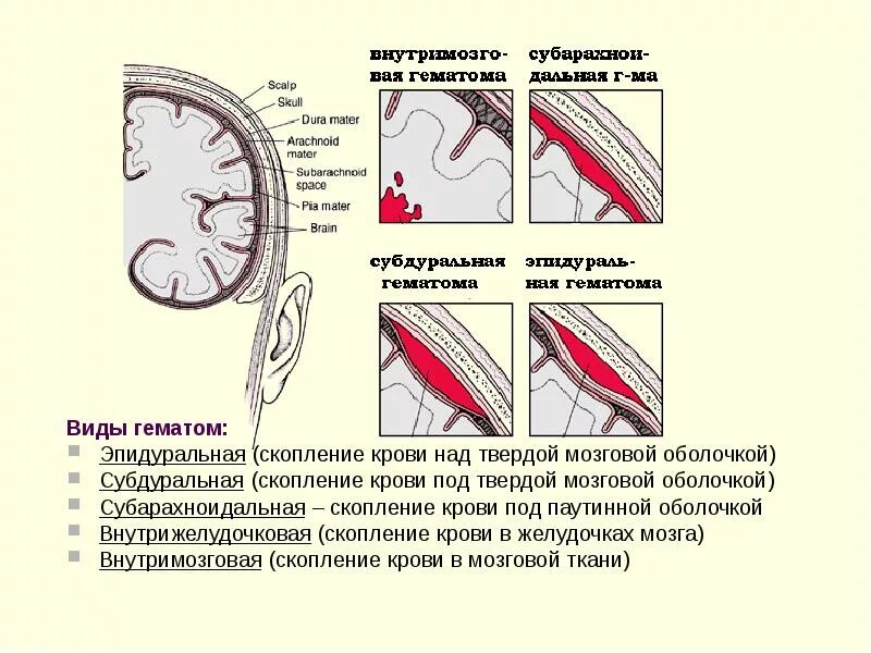 Подострая субдуральная гематома на кт. Пластинчатая субдуральная гематома головного мозга. Гематомы головного мозга классификация. Виды гематом головного мозга. Виды гематом головного мозга.