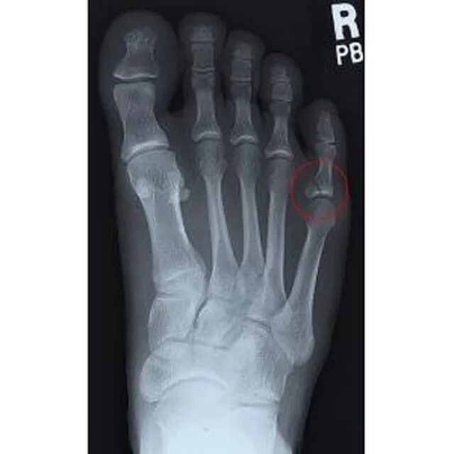 Перелом основной фаланги пальца стопы. Экзостоз дистальной фаланги 1 пальца стопы. Перелом основной фаланги 1 пальца стопы рентген. Внутрисуставной перелом фаланги стопы. Оскольчатый перелом пальца ноги рентген.