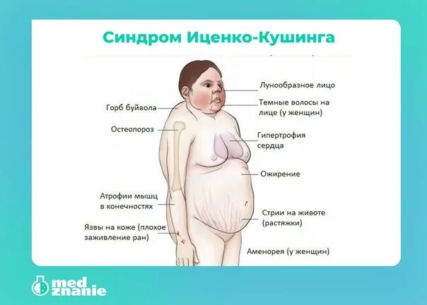 Преднизолон синдром кушинга. Симптомокомплекс иценко кушинга. кортизол при иценко кушинга. синдром гиперкортицизма иценко кушинга. лунообразное лицо иценко-кушинга.