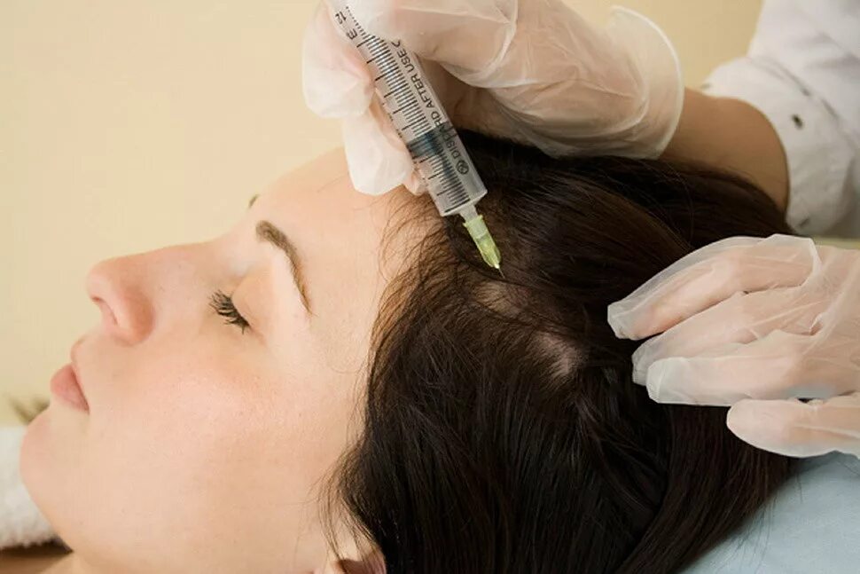 Озонотерапия уколы. Мезотерапия для волос. Мезотерапия кожи головы. Инъекции для волос. Мезо для волос.