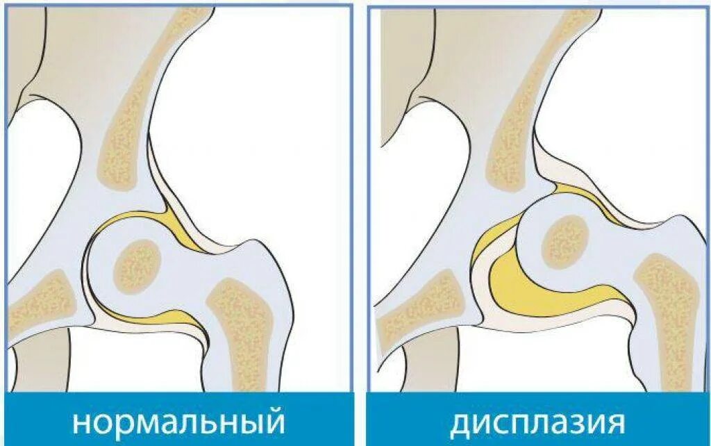 Тазобедренного сустава у детей. Дисплазия тазобедренных суставов. дисплазия тазобедренных суставов тип 2 с. дисплазия тазобедренного сустава у младенца. дисплазия дистального отдела бедренной кости.