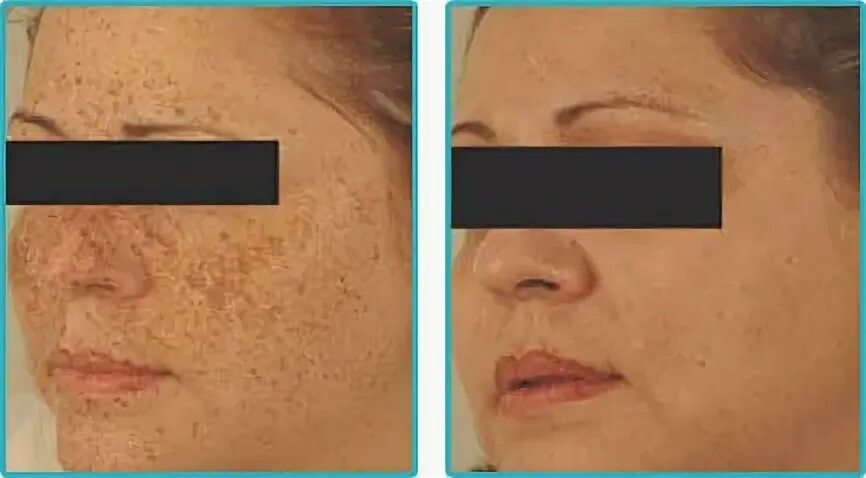 Косметическая шлифовка лица. Лазерная шлифовка ростов. Лазерная шлифовка лица от шрамов. Микродермабразия рубцов. Лазерная шлифовка кожи до и после.