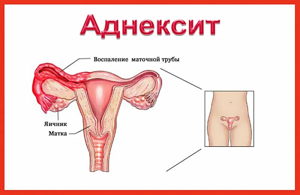 Где матка и яичники. Воспаление маточных труб. Аднексит (воспаление придатков). Левосторонний аднексит. Матка, маточная труба и яичник, придатки..