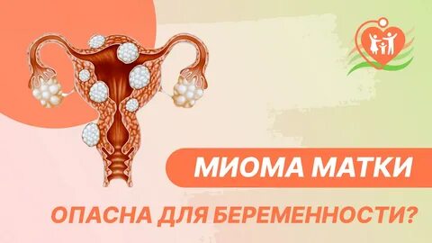 Опасно ли миома матки для жизни