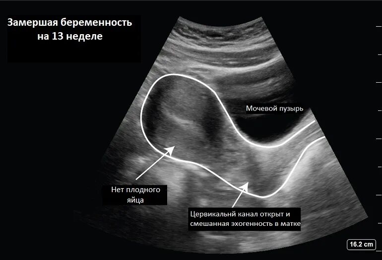 Замершая беременность признаки на ранних сроках. Замирание беременности. Замершая беременность по УЗИ. Замерзшая беременность на УЗИ.