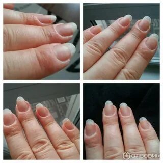 Аллергия на лампу