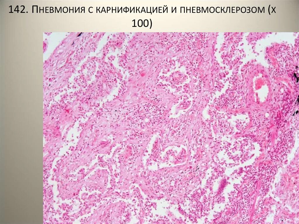 Пневмосклероз гистология. Пневмония с карнификацией. Пневмосклероз патологическая анатомия. Хронический бронхит с бронхоэктазами микропрепарат.