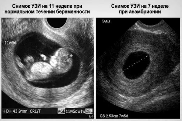 Замершая беременность УЗИ. Неразвивающаяся беременность. Эмбрион на УЗИ на раннем сроке. Можно перепутать беременность с кистой
