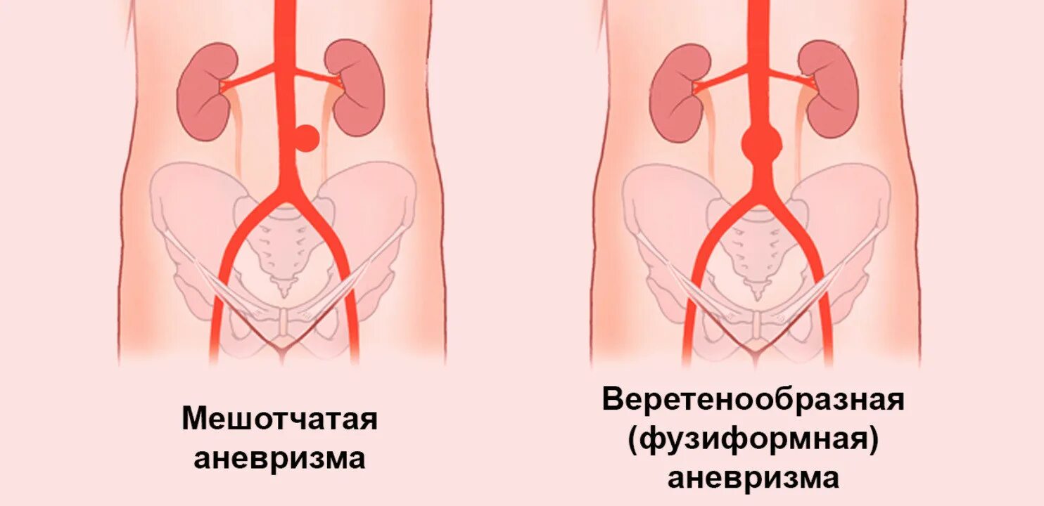 Аневризма брюшной аорты симптомы лечение. Веретенообразная аневризма. мешотчатая аневризма брюшной аорты. разрыв аневризмы брюшной аорты. аневризма брюшной аорты симптомы.