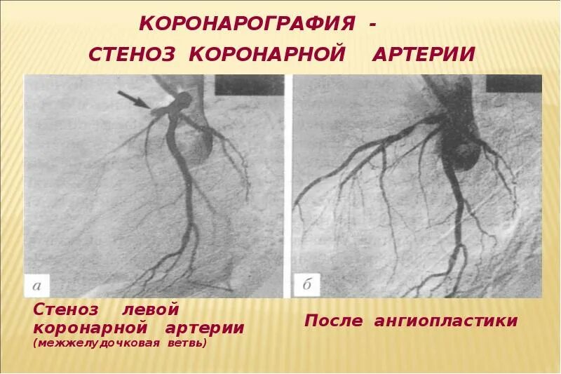 Коронарография сердца стеноз. Стеноз левой коронарной артерии. Коронарография стеноз ствола. Коронарография стеноз ПМЖВ.