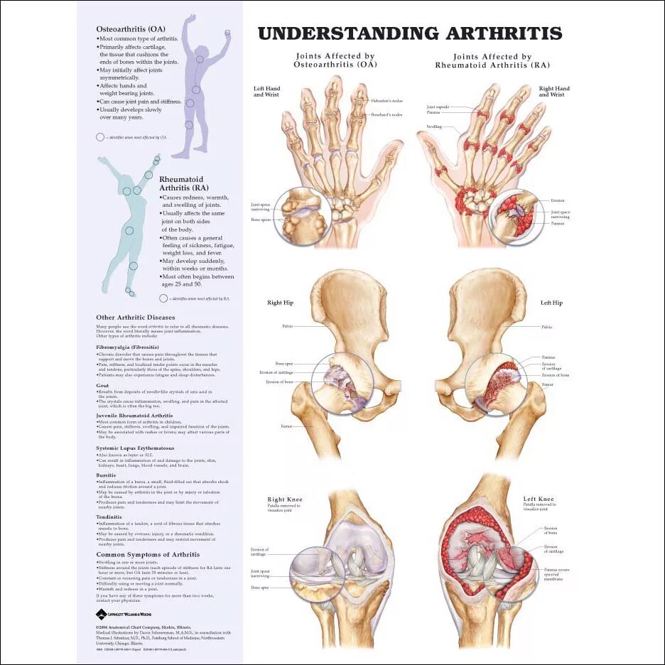Типы артритов. Суставы человека анатомия. Ревматоидный артрит типы.