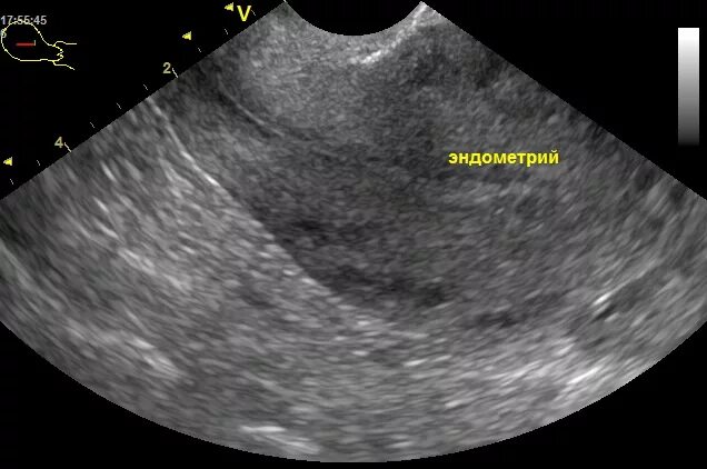 Эндометрий 1 мм. Неоднородный эндометрий 12 мм. Неоднородность эндометрия на УЗИ что это. УЗИ ОМТ эндометрий. УЗИ эндометриоза матки.