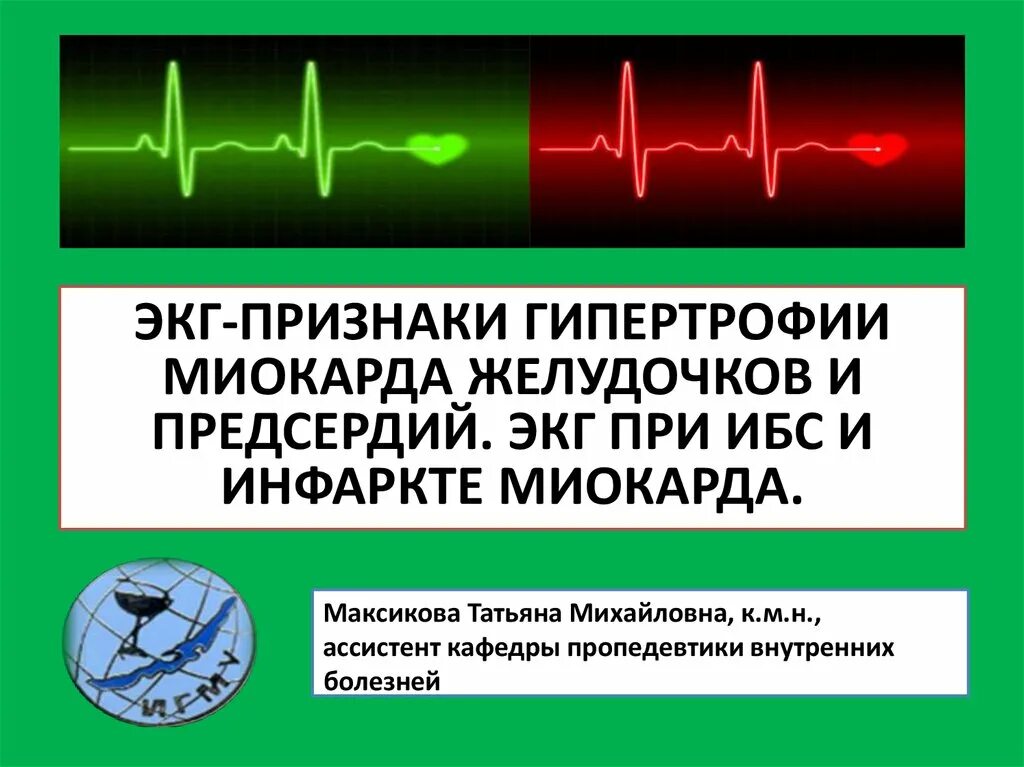 Болезни на экг. Критерии ишемии миокарда на ЭКГ. Ишемия миокарда на ЭКГ. ЭКГ при ишемической болезни сердца. ЭКГ пропедевтика внутренних.