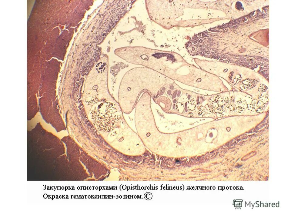 острый описторхоз клиника. описторхоз в желчном. инфекционный описторхоз. описторхоз гистология. описторхоз желчные протоки.