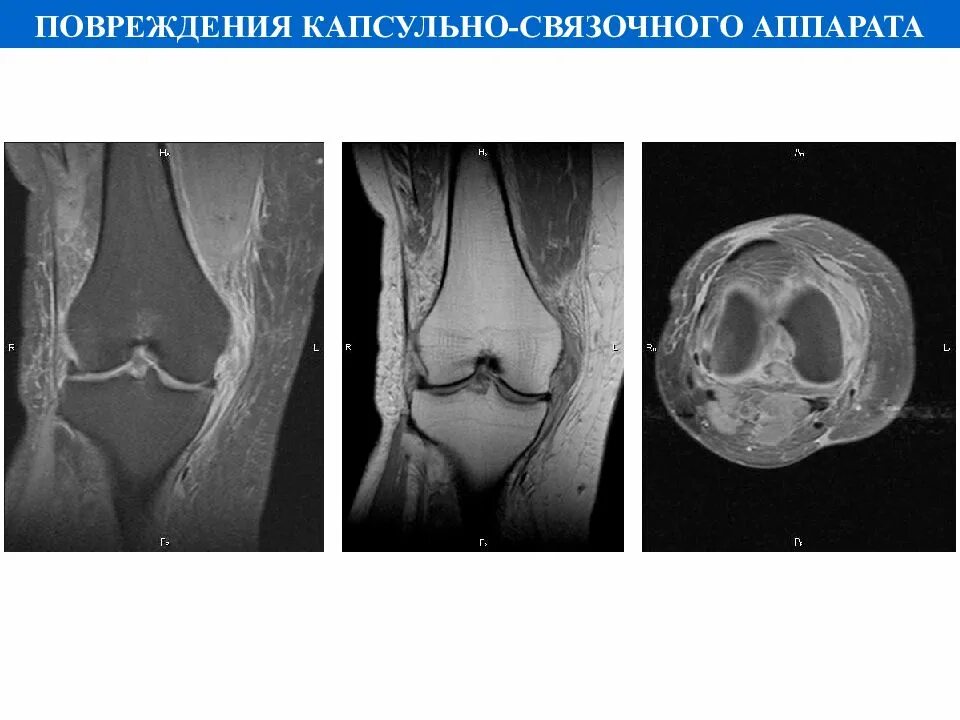 Разрыв капсульно связочного аппарата. Капсульно-связочный аппарат коленного сустава. Повреждение капсульно-связочного аппарата коленного сустава. Разрыв капсульно связочного аппарата колена.