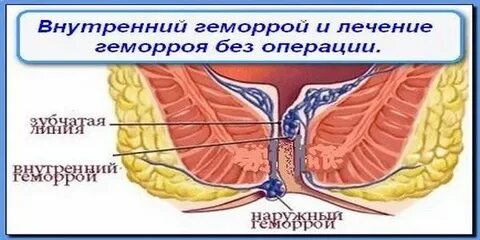 Операция геморроя сколько реабилитация