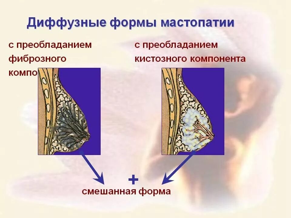 Фиброзно-кистозная мастопатия диффузная Узловая. Фиброзная мастопатия молочной железы что это. Диффузная, диффузно-Узловая, фиброзно- кистозная, Узловая мастопатия. Диффузная кистозная мастопатия. Признаки фиброзных изменений молочных желез