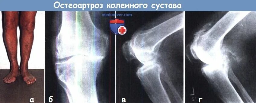 Что такое остеофиты коленного сустава как лечить. Остеофиты коленного сустава. остеофиты коленного сустава фото. остеофиты на суставах колена фото на теле. остеофиты как выглядят на колене.