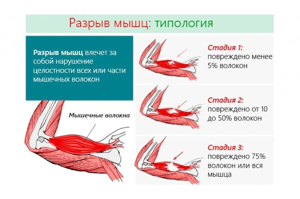 Разрыв мышц признаки. Микро разрыв мышечных волокон при тренировках.