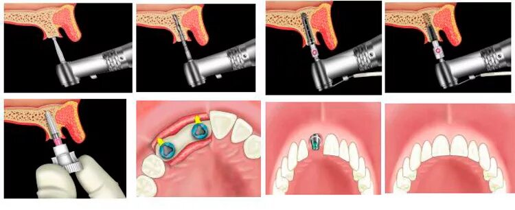 Зубы импланты поэтапно. Одноэтапная методика имплантации. Хирургический этап дентальной имплантации. Этапы имплантации зубов. Вставка имплантов зубов.