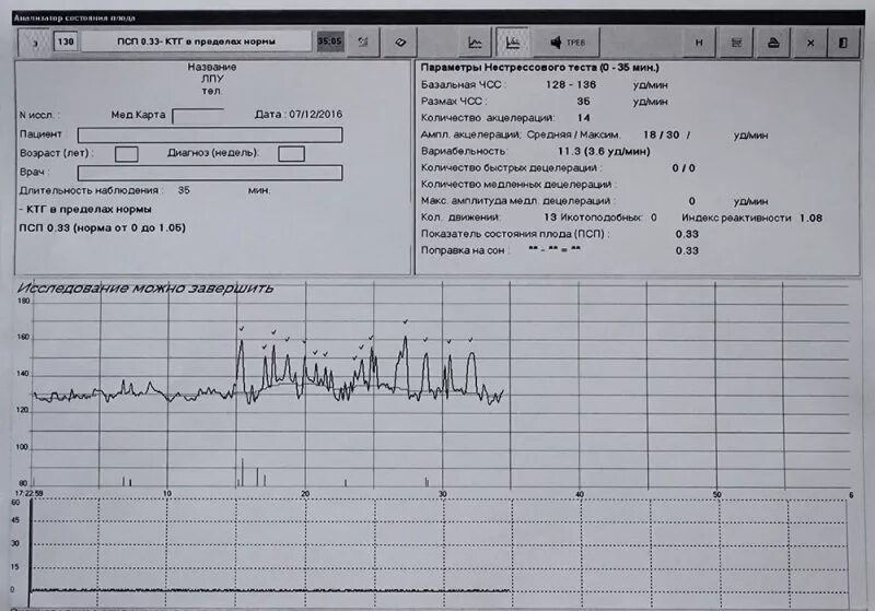 ПСП показатель при КТГ беременным. ПСП плода на КТГ норма. ПСП КТГ при беременности норма. ПСП при КТГ при беременности норма. Нормы ктг 33 недели
