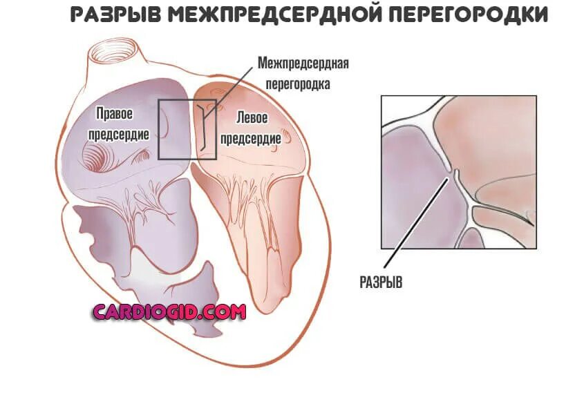 Разрывы отрыва. Разрыв межпредсердной перегородки. Разрыв сердечной перегородки. Разрыв межжелудочковой перегородки. Наружный разрыв сердца.