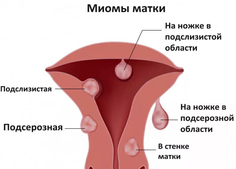 Миома на задней стенке матки