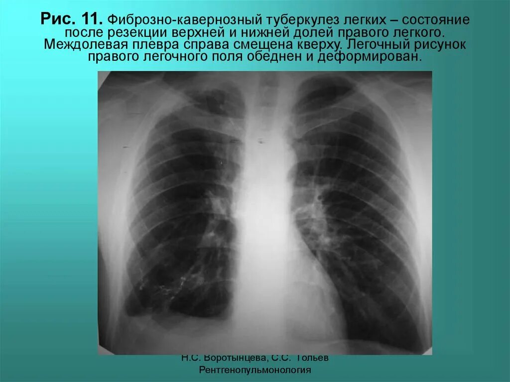 Умеренные фиброзные изменения. Кавернозный туберкулез каверна. Кавернозный туберкулез фтизиатрия. Левосторонний междолевой плеврит. Фиброзно-кавернозный туберкулез легкого.