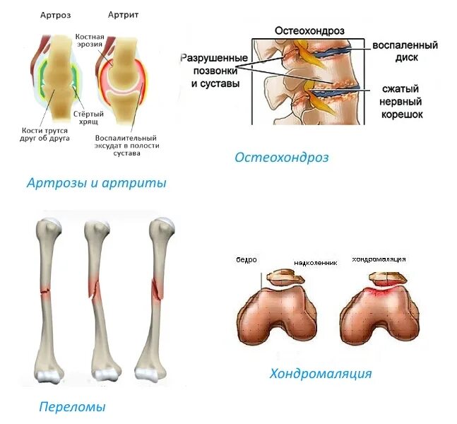 Артрит и артроз разница