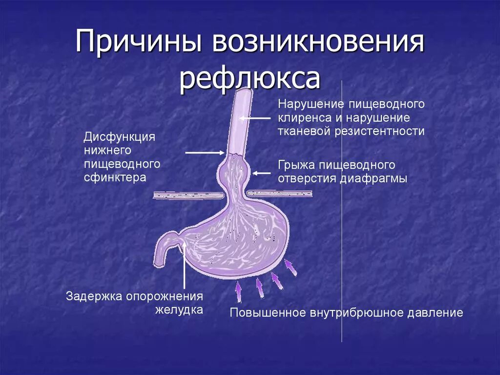 Гастроэзофагеальный рефлюкс. Пищеводные проявления ГЭРБ. Ларингофарингеальный рефлюкс. Лечение гастроэзофагеального рефлюкса у взрослых