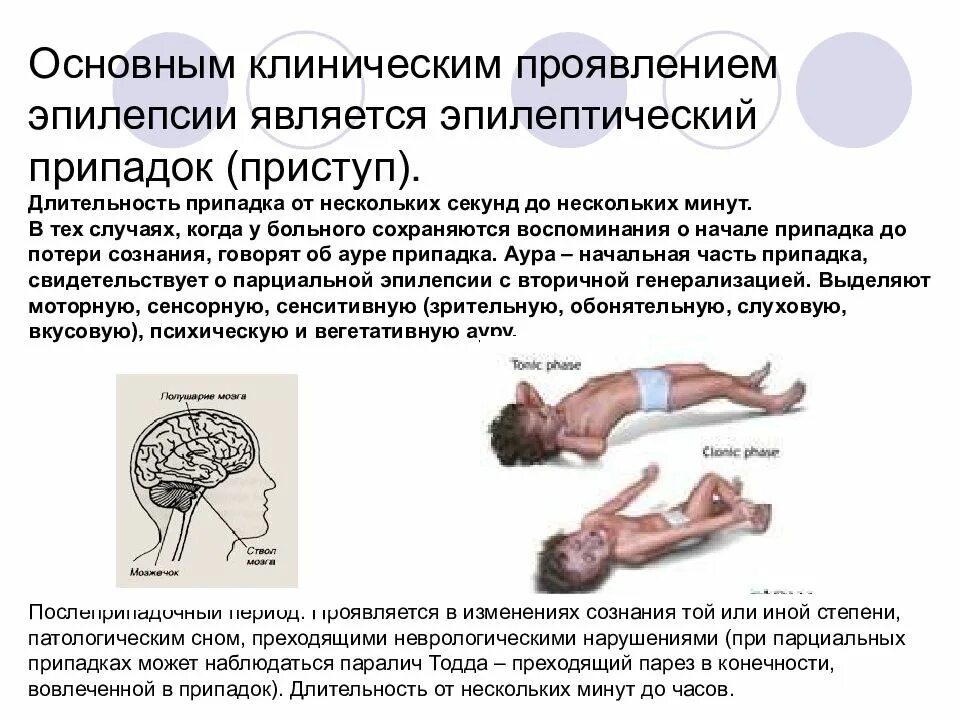 Почему есть судороги. Эпилептический припадок клинические симптомы. Судорожный приступ эпилепсии. Судороги при эпилепсии у детей описание. Эпилепсия судорожные пароксизмы.