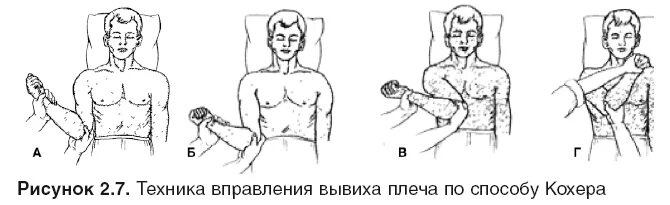Лечение плеча после вправления. Вывих плеча метод кохера. Методы вправления вывиха плеча. Вправление вывиха методом кохера. Метод кохера вправление плеча.