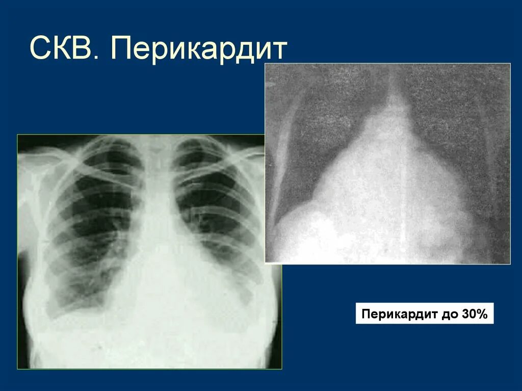 Красная волчанка легких. Дифференциальная диагностика скв и системной склеродермии. Красная волчанка легких. Красная волчанка легких. Красная волчанка легких.