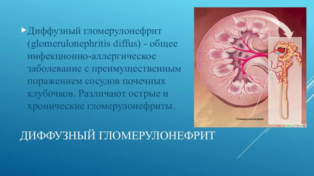 Гломерулонефрит что это. Диффузный гломерулонефрит. острый диффузный гломерулонефрит. хронический диффузный гломерулонефрит. гломерулонефрит у детей презентация.