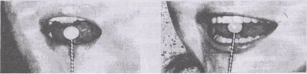 Постановка р зондом. Зонд для свистящих звуков. Шариковый зонд для постановки звука р. Зонд для постановки звука с. Логопедические зонды для р.