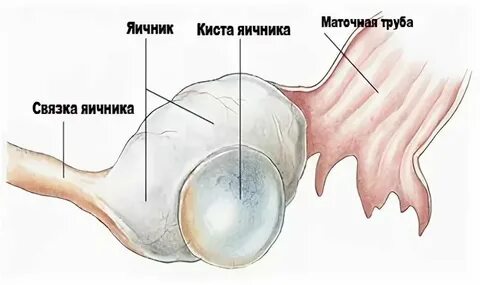Транспозиция яичников