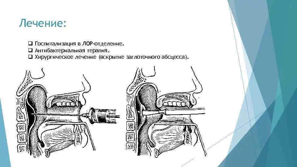 Эпифарингеальный заглоточный абсцесс. Паратонзиллярный и заглоточный абсцесс. Назофарингеальный заглоточный абсцесс. Абсцесс заглоточного пространства. Глотка лор