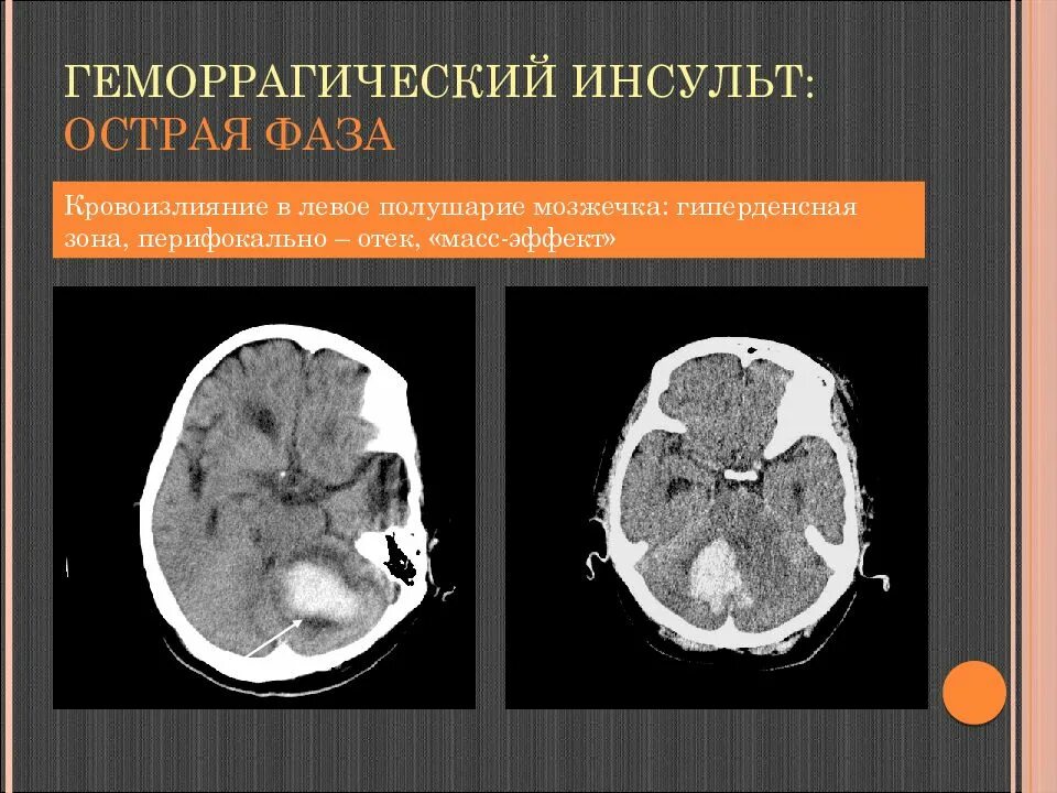 Ишемический инсульт мозжечка кт. Геморрагический инсульт в мозжечке мрт. Ишемический инсульт мозжечка головного мозга кт. Ишемический инсульт с кровоизлиянием на кт.