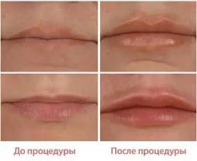 Формы полов губ