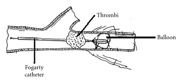 Катетер фогарти. Баллонный катетер Фогарти. Зонд Фогарти. Тромбэктомия катетером Фогарти. Тромбэктомия зондом Фогарти.