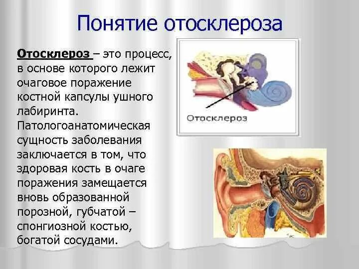 Отосклероз стапедопластика. Отосклероз слухового прохода. Причины болезни отосклероз. Отосклероз клинические рекомендации. Отосклероз уха операция