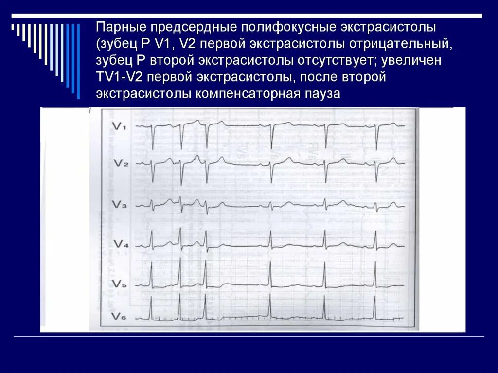 Предсердные экстрасистолы на ЭКГ. Парная суправентрикулярная экстрасистолия. Парная блокированная предсердная экстрасистола. Блокированные предсердные экстрасистолы на ЭКГ. Блокированные экстрасистолы