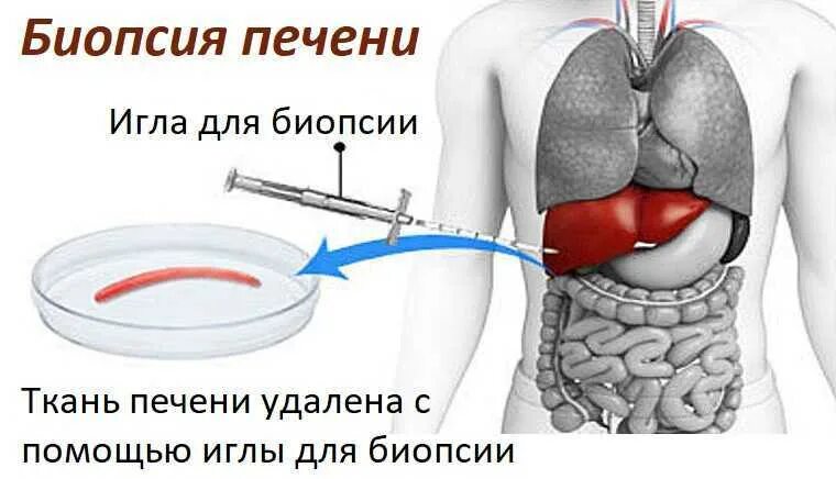 Пункционная биопсия печени. Тонкоигольная аспирационная биопсия печени. Пунктуауионная биопсия печени. Чрескожная пункционная биопсия печени.